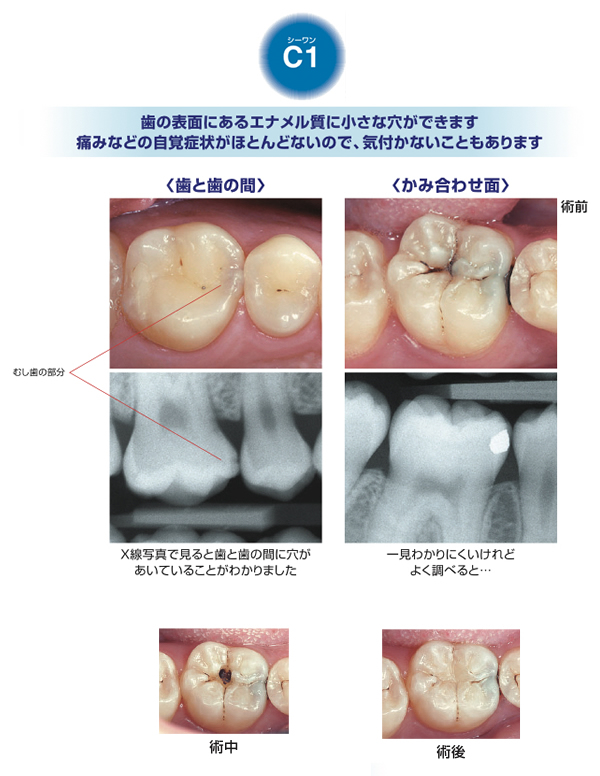 c1 虫歯 治っ た